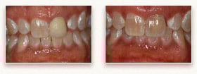 Before and After Crowns