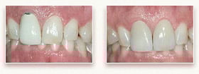 Before and After Porcelain Crowns & Porcelain Veneers