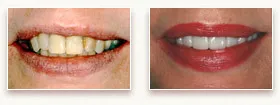 Before and After Porcelain Crowns & Porcelain Veneers