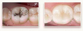 Before and After Tooth Colored Fillings