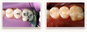 Before and After  Tooth Colored Fillings
