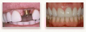 Before and After Dental Implants