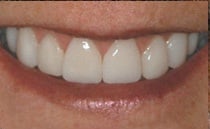 Featured Case after photo