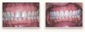 Before and After Porcelain Veneers